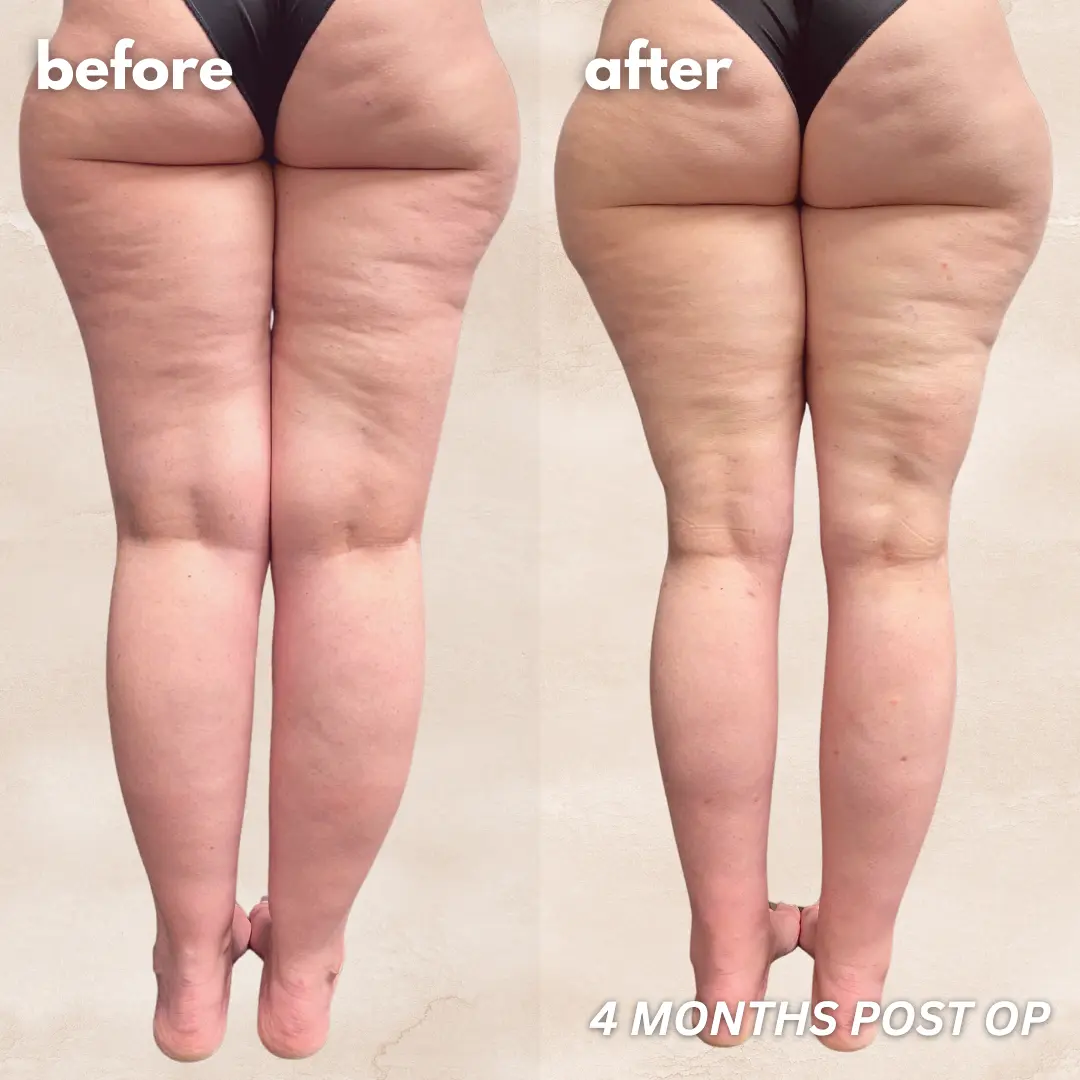 Patient before and after — LippyLipo result