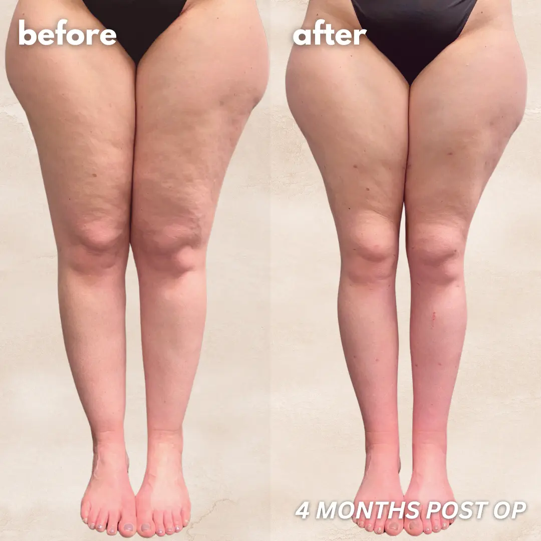 Patient before and after — LippyLipo result