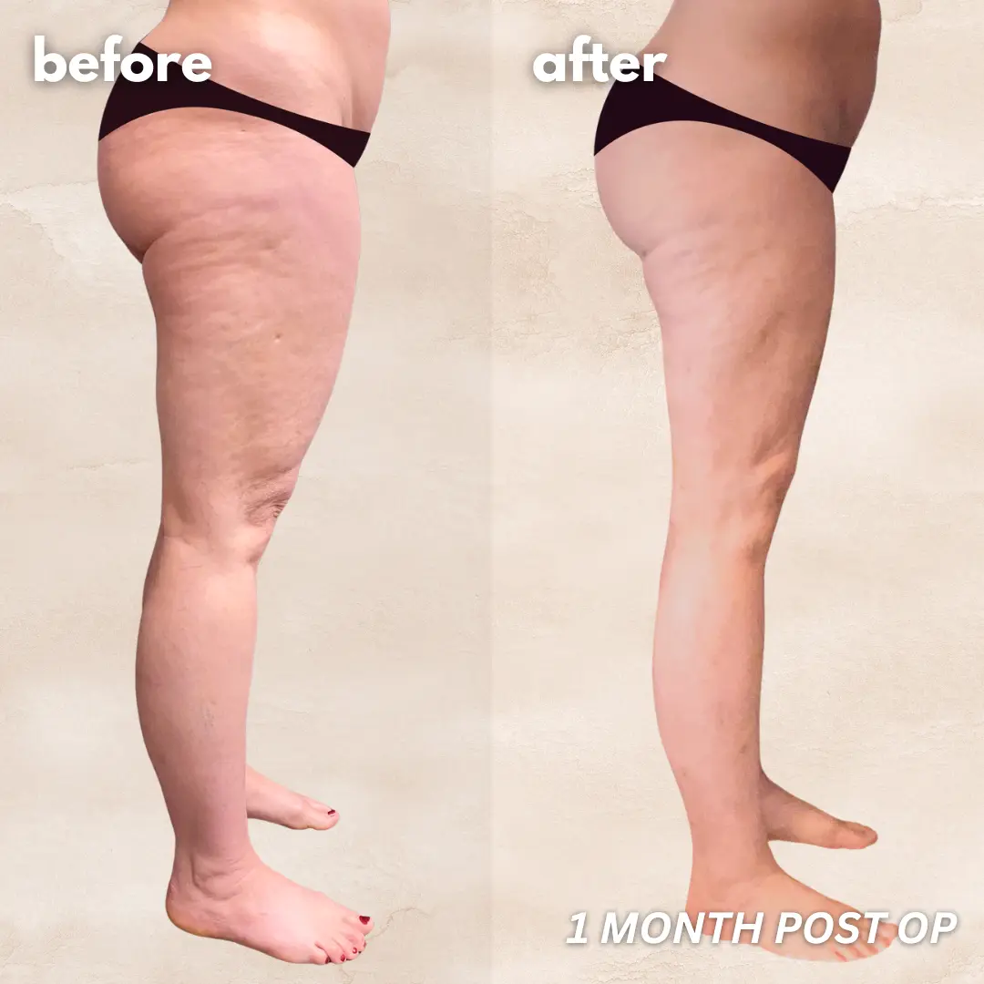 Patient before and after — LippyLipo result