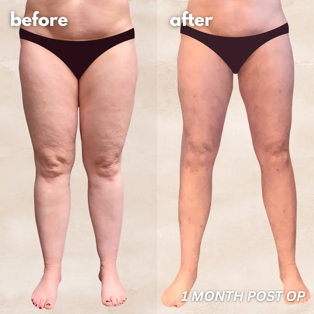 Patient before and after — LippyLipo result