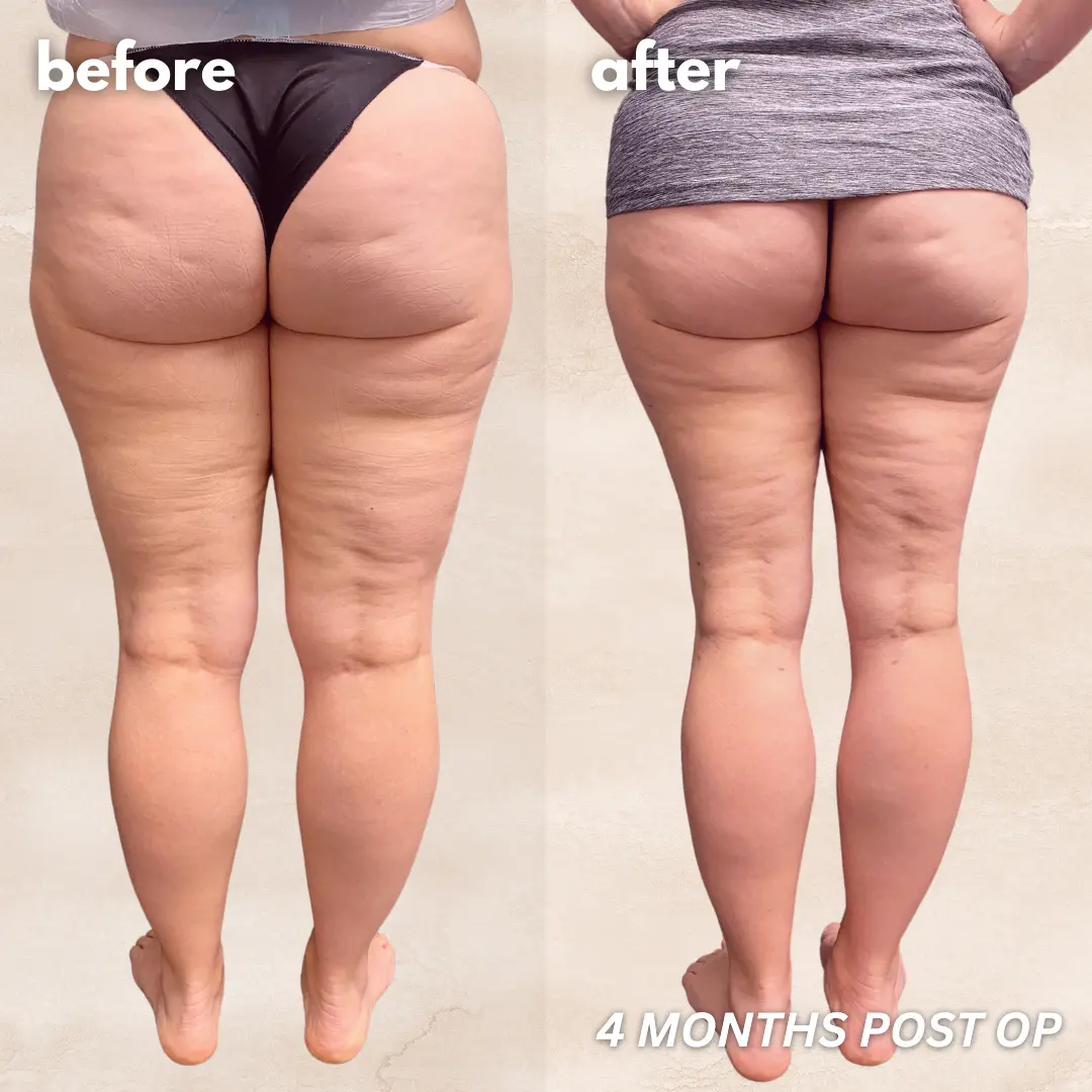 Patient before and after — LippyLipo result