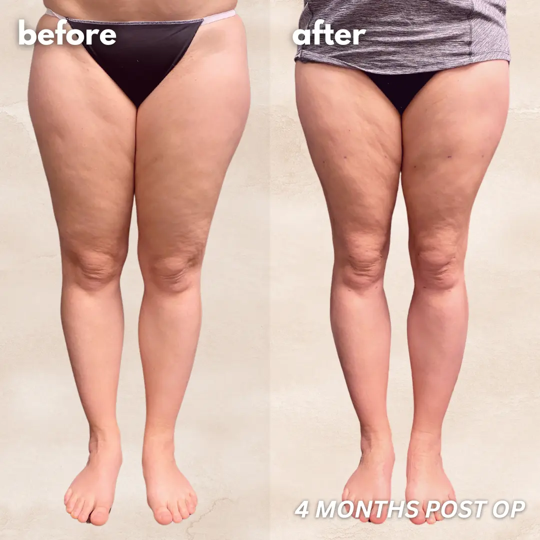 Patient before and after — LippyLipo result