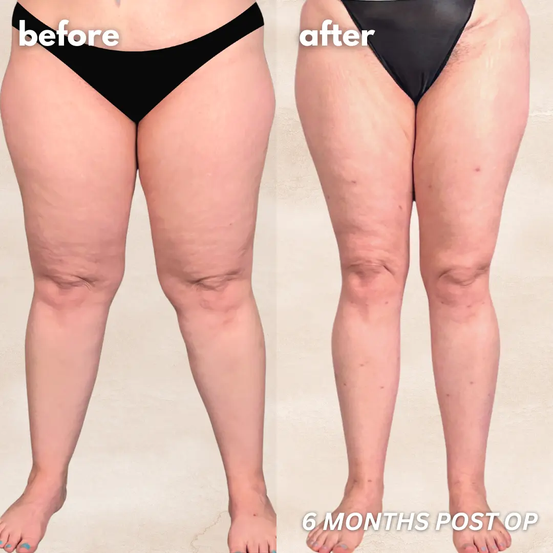 Patient before and after — LippyLipo result, 6 months post-op