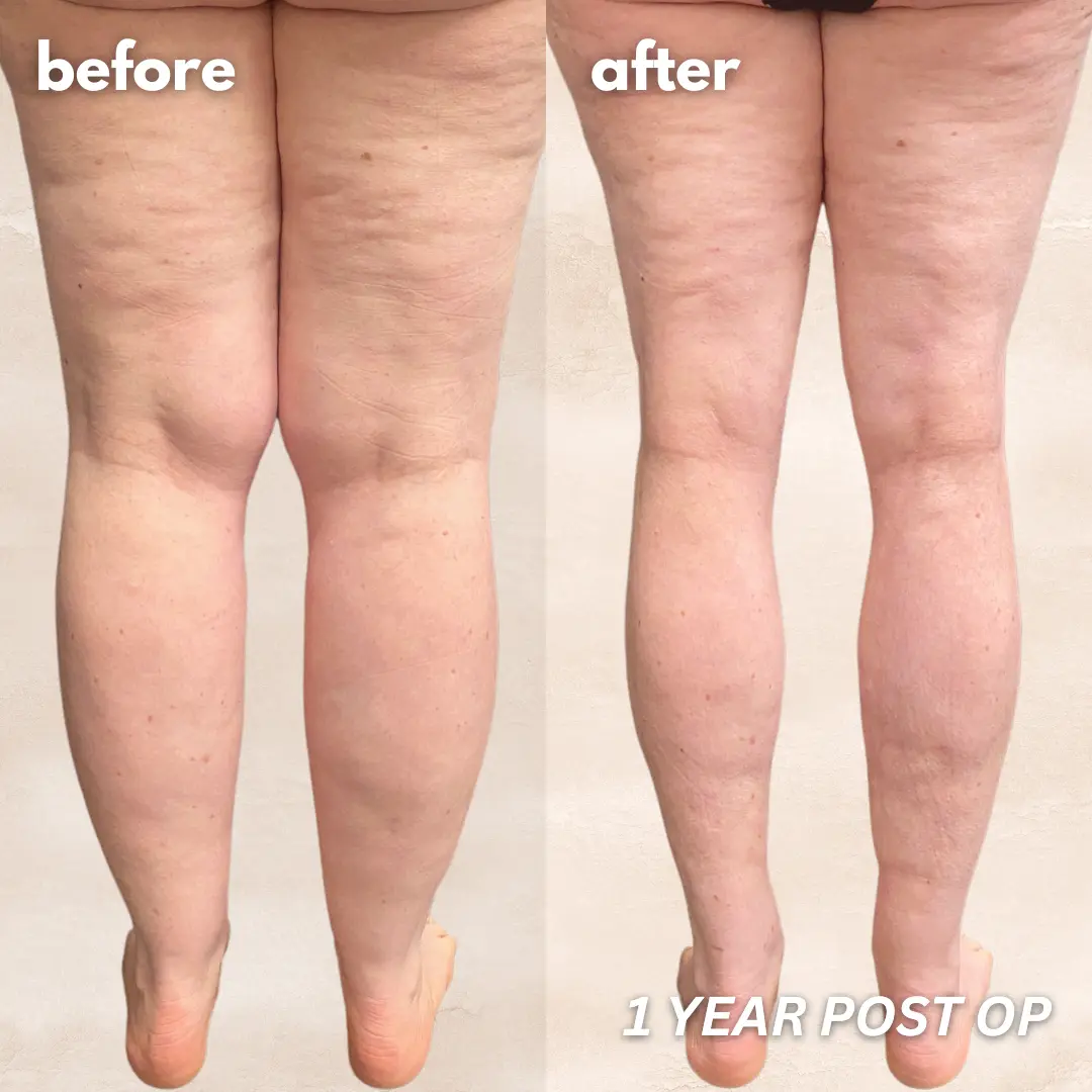 Patient before and after — LippyLipo result, back view