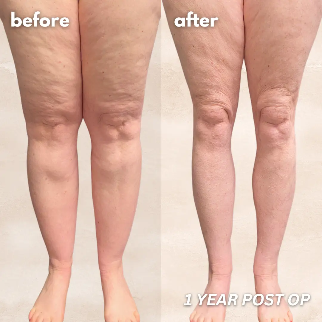 Patient before and after — LippyLipo result, front view