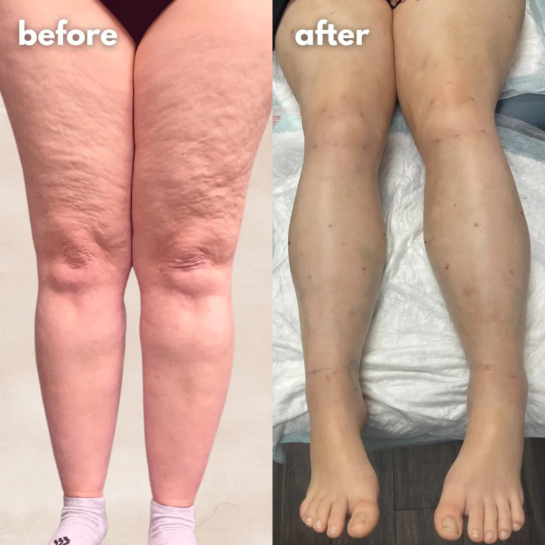 Patient before and after — LippyLipo result
