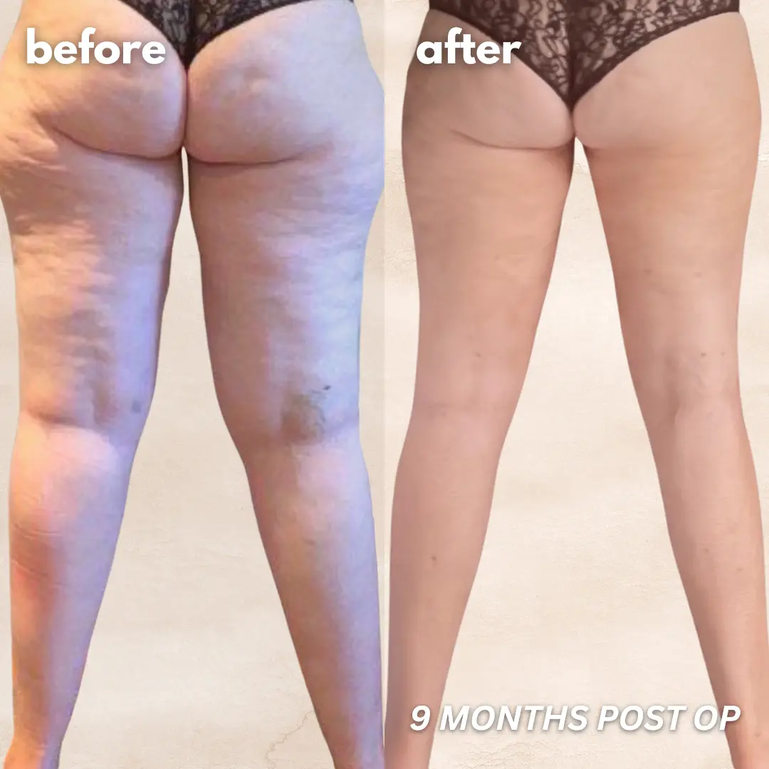 Patient before and after — LippyLipo result, back view