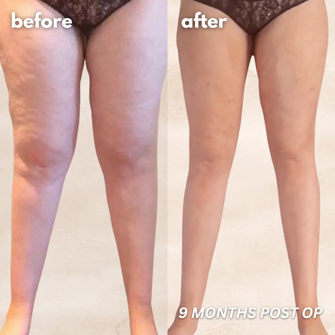 Patient before and after — LippyLipo result, front view